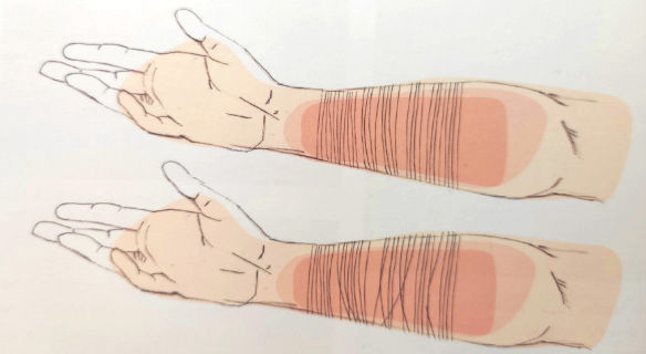 Model zniekształcenia powięzi 